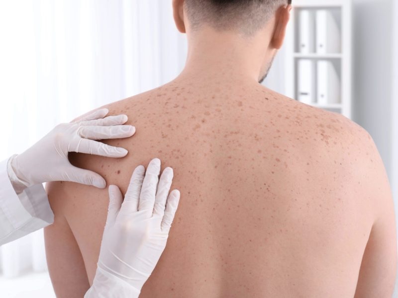 Schönheit ohne Falten: Botox-Injektionen zur effektiven Glättung von Mimikfalten