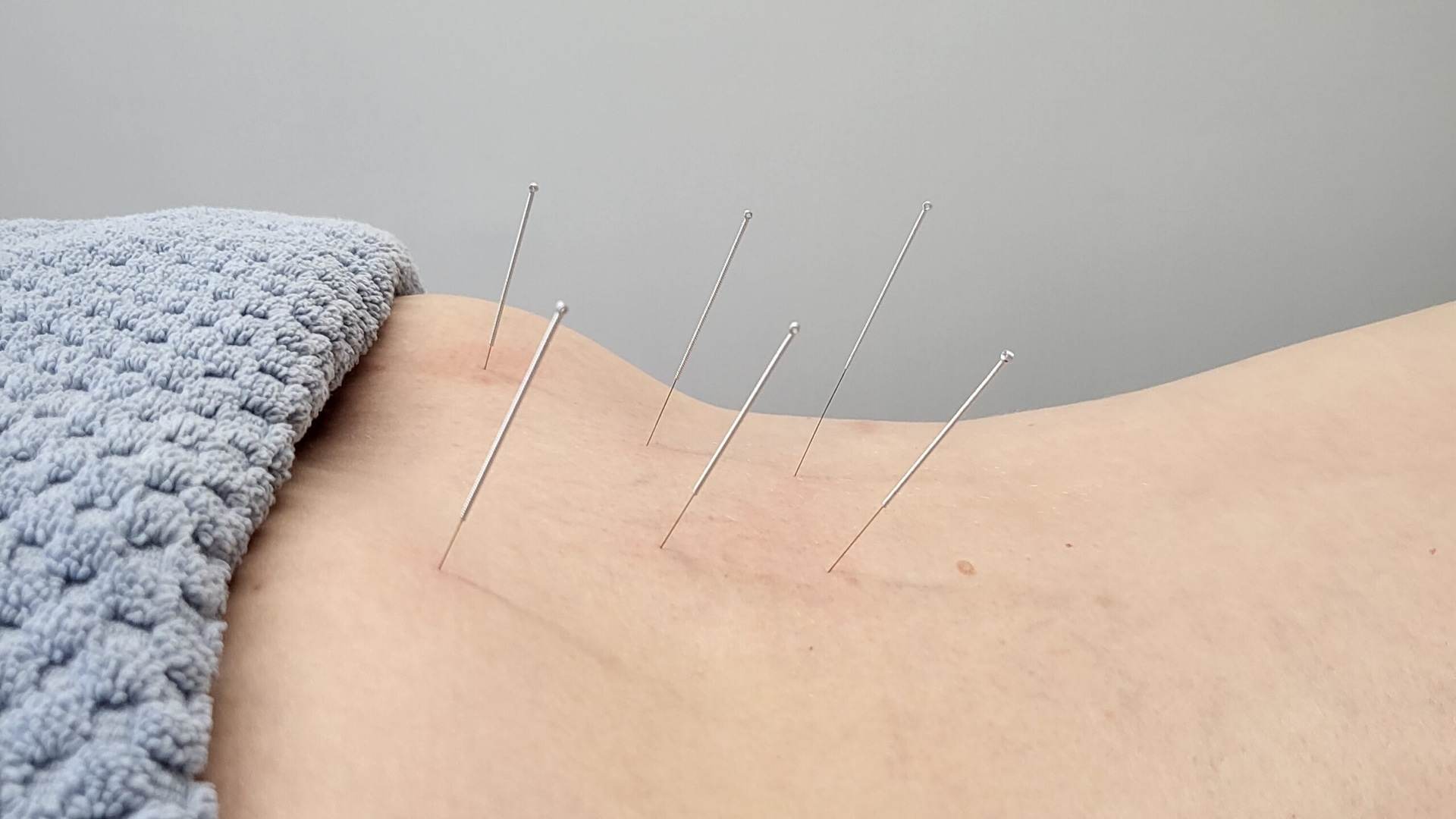 Hogyan működik az akupunktura? – Akupunkturbehandlungen usw válaszol